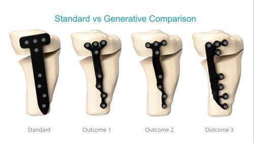 Future of Fracture Fixation: A Generative Design Approach to Surgical Implants -part (2/2)